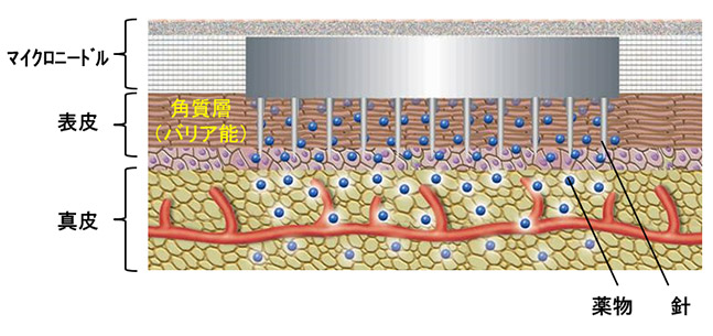 マイクロニードル テクノロジー