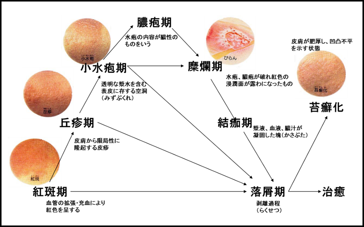 紅斑期-血管の拡張・充血により紅色を呈する 丘疹期-皮膚から限局性に隆起する皮疹 小水疱期-透明な漿水うを含む表皮に存する空洞（みずぶくれ） 膿疱期-水泡の内容が膿性のものをいう 糜爛期-水泡、膿疱が破れ紅色の浸潤面が露わになったもの 結痂期-漿液、血液、膿汁が凝固した塊（かさぶた） 落屑期-剥離過程（らくせつ） 苔癬化-皮膚が肥厚し、凹凸不平を示す状態 治癒